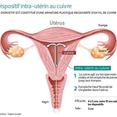 Sante 201747 intra uterincuivre